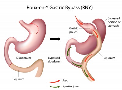 Tratamiento-Bypass-gastrico
