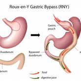 Bypass_gastrico